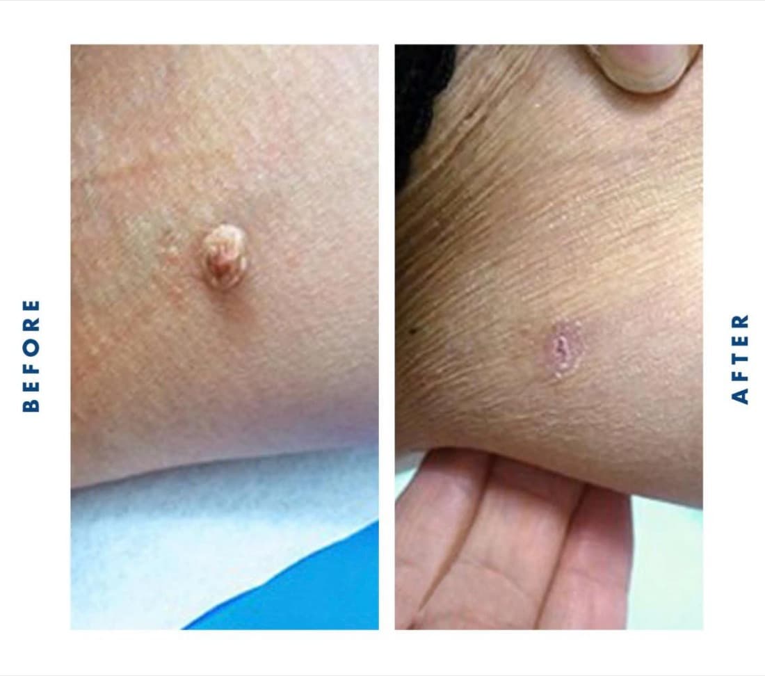 CryoClear treatment result