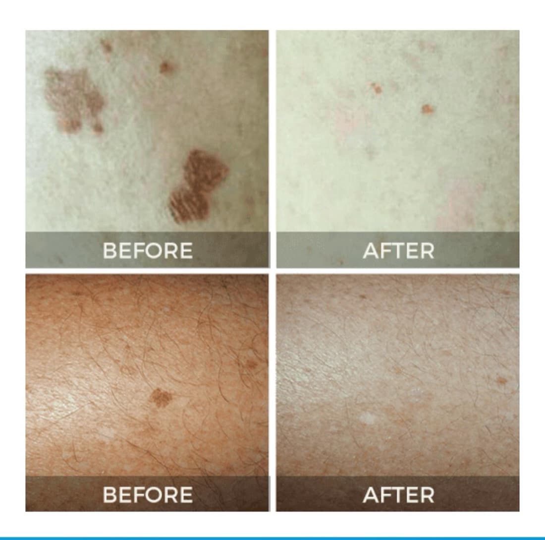 CryoClear Pen