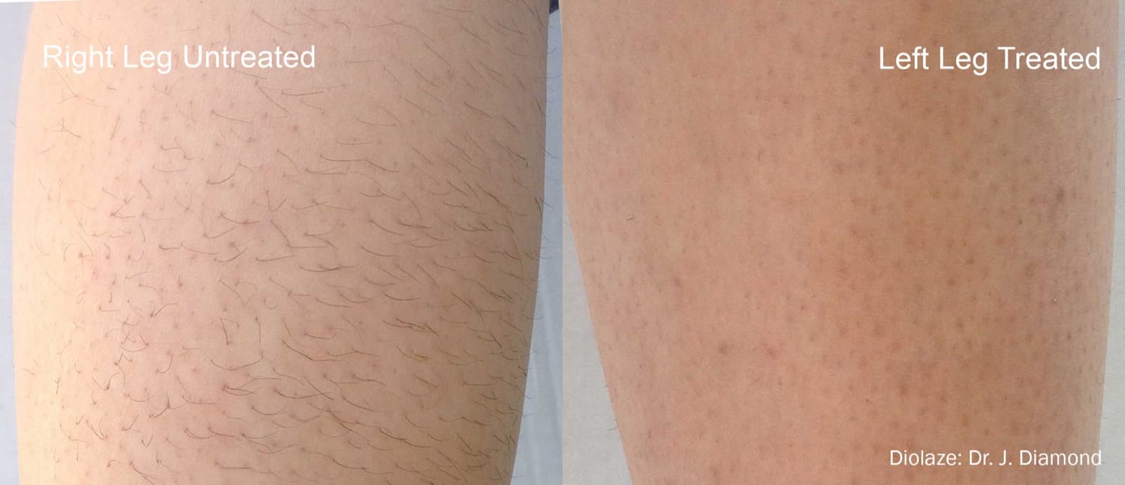 Diolaze XL laser hair removal treatment