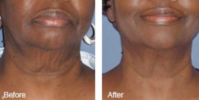 FORMA skin tightening before and after results