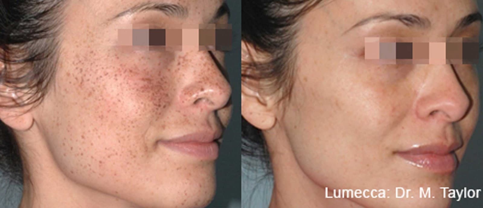 Lumecca IPL treatment