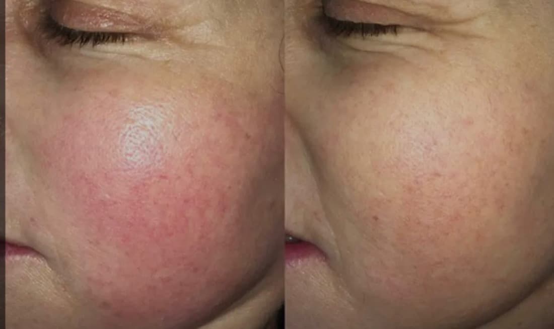 Procell Microchanneling treatment