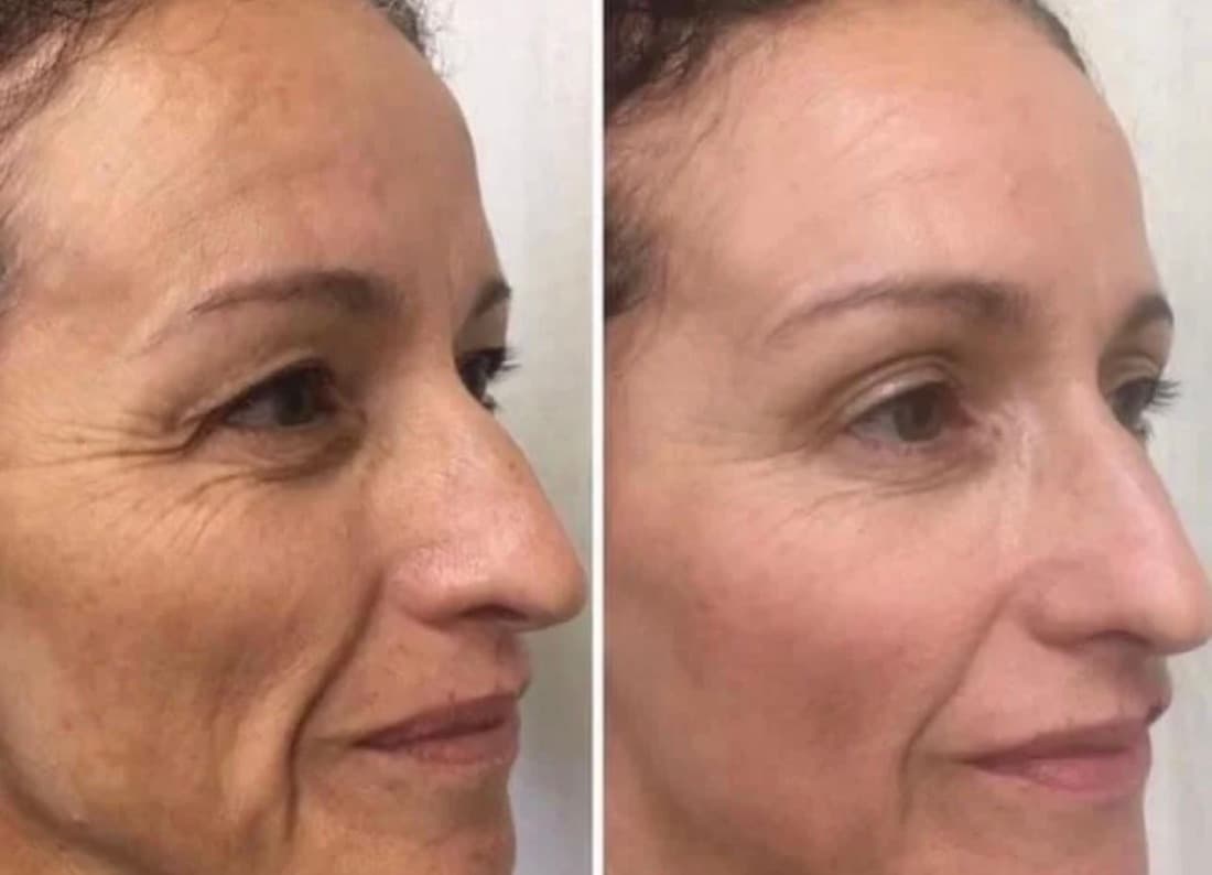 Procell Microchanneling result