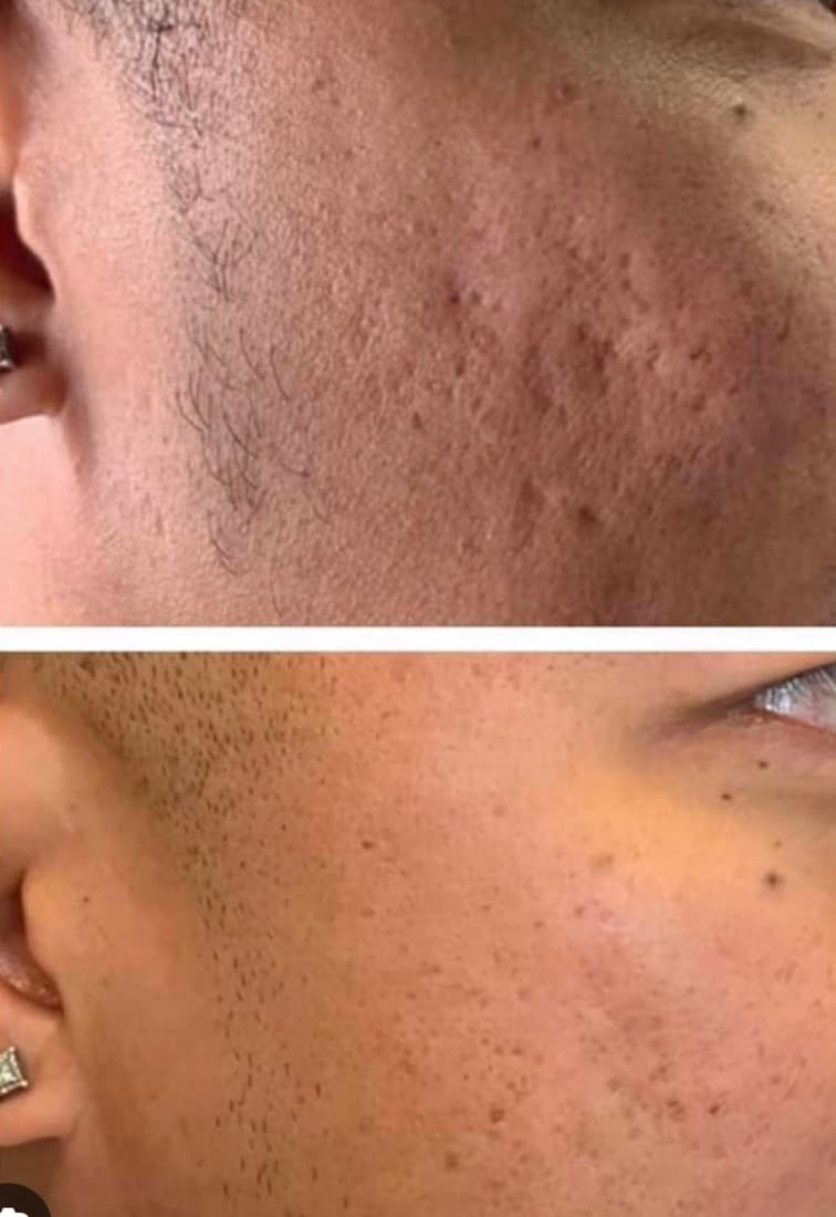 Procell Microchanneling result